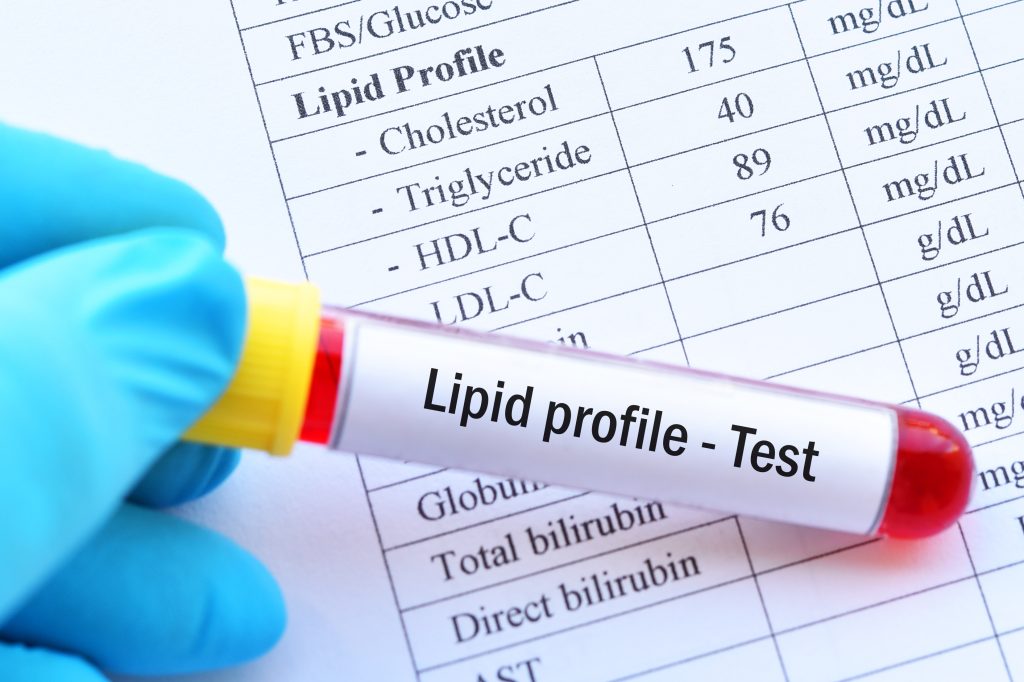 Tyrimų kompleksas „Lipidograma cholesteroliui išsitirti“