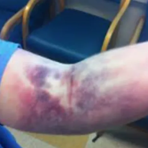 Hematoma
