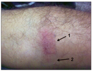 alerginis kontaktinis dermatitas