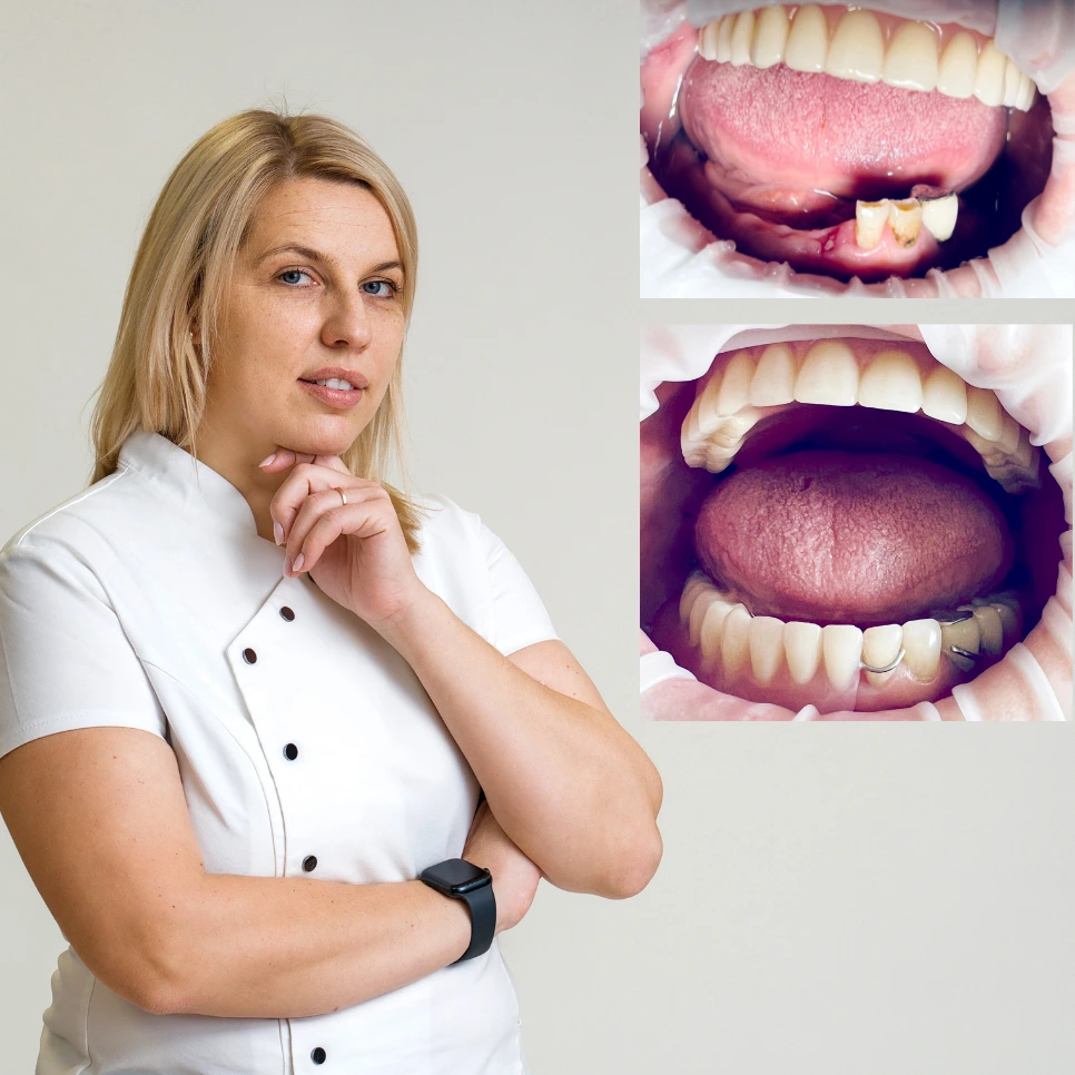 Estetinis-plombavimas